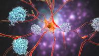 Brain with Alzheimer's